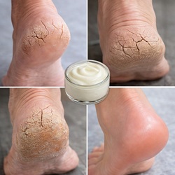 Çatlak topuklardan kurtulun işte evde yapabilecekleriniz